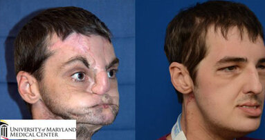 Amerikaner erhält nach Schussverletzung neues Gesicht