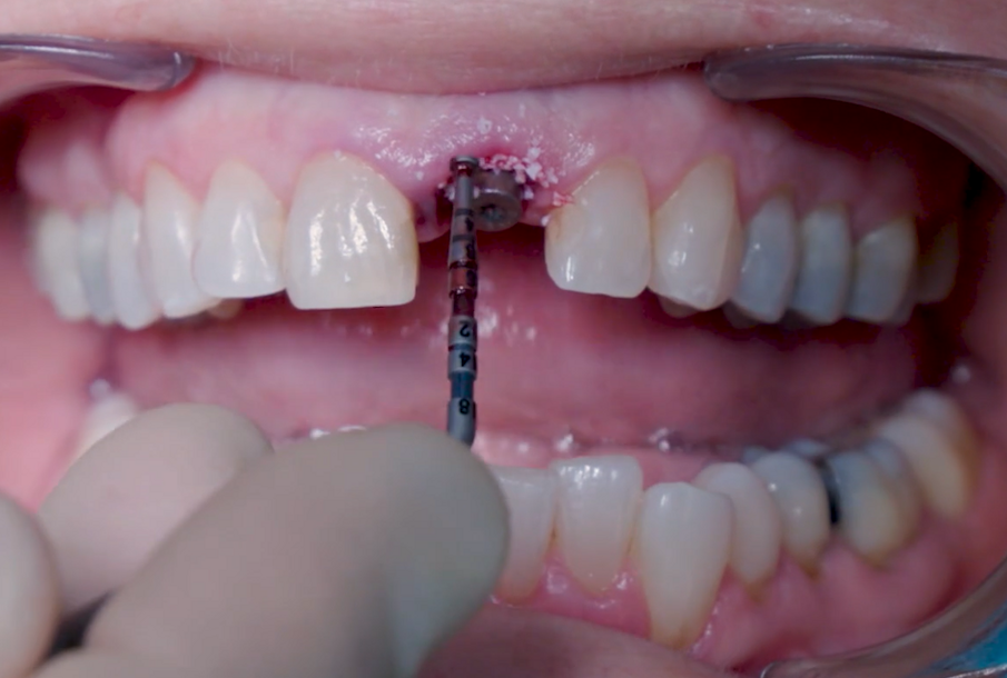 Fig. 16_Condensazione dei granuli con sonda chirurgica.