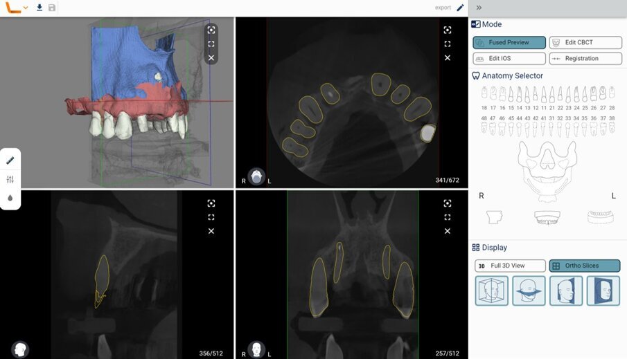 Fig. 5_Il software di Intelligenza Artificiale (Virtual Patient Creator, RELU) è in grado di segmentare autonomamente ciascuna struttura anatomica in meno di 10 minuti: il tempo di un caffè.