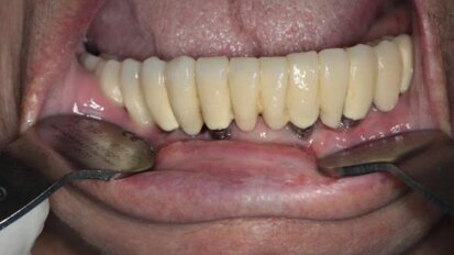 Periimplantitis – przegląd piśmiennictwa w oparciu o wybrane przypadki własne