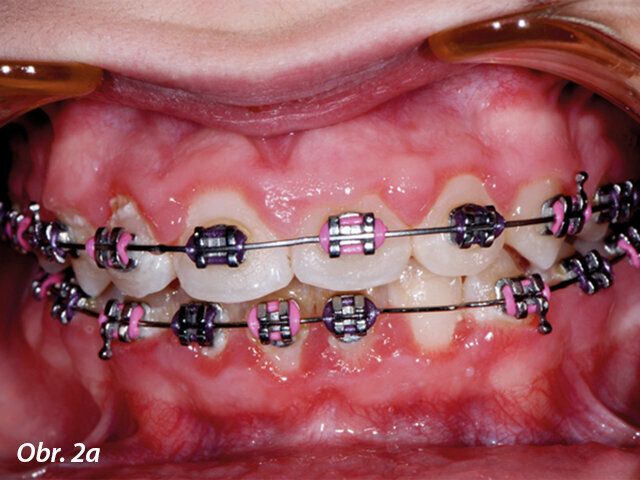 Hyperplazie gingivy před ošetřením.