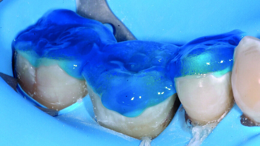 Fig. 13 : Mordançage à l’acide orthophosphorique 30 % pendant 30 secondes, rincé, séché.