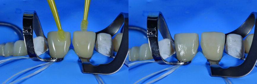 Fig. 16c : Application de l’agent de collage. |Fig. 16d : Polymérisation finale des facettes.