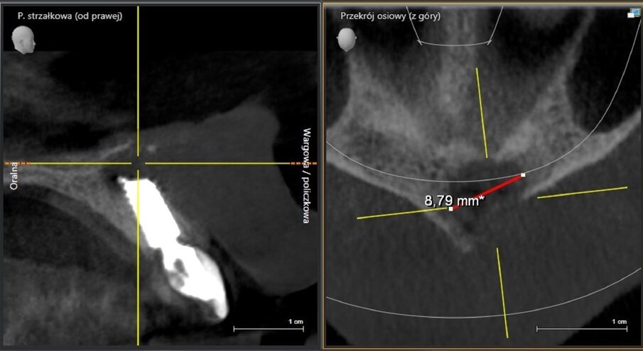 Fig. 18: CBCT scan on the day of surgery. No bone augmentation.
