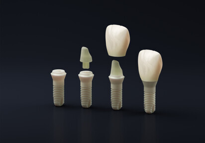 Patent Dental Implant System