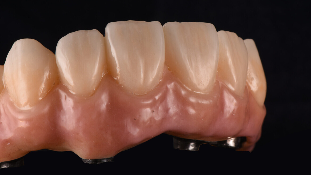 Figs. 6a & b: Lifelike colour, translucency and surface texture of the gingival and dental areas. 