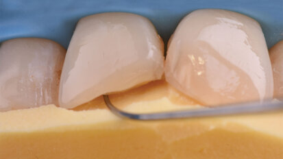 Life-Like IV klasa u dve kompozitne mase