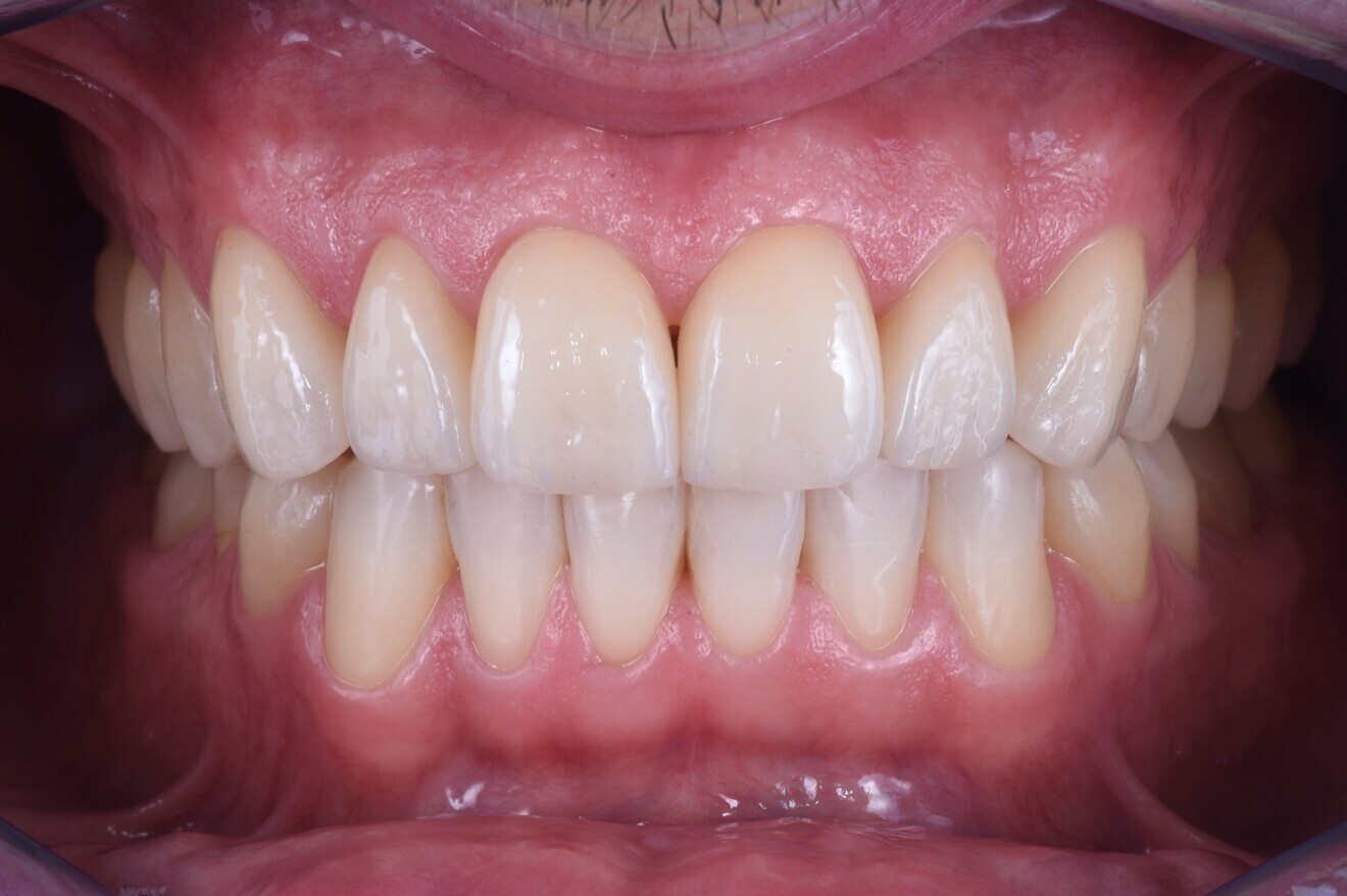 Figs. 17a-c: Final intra-oral photographs. 