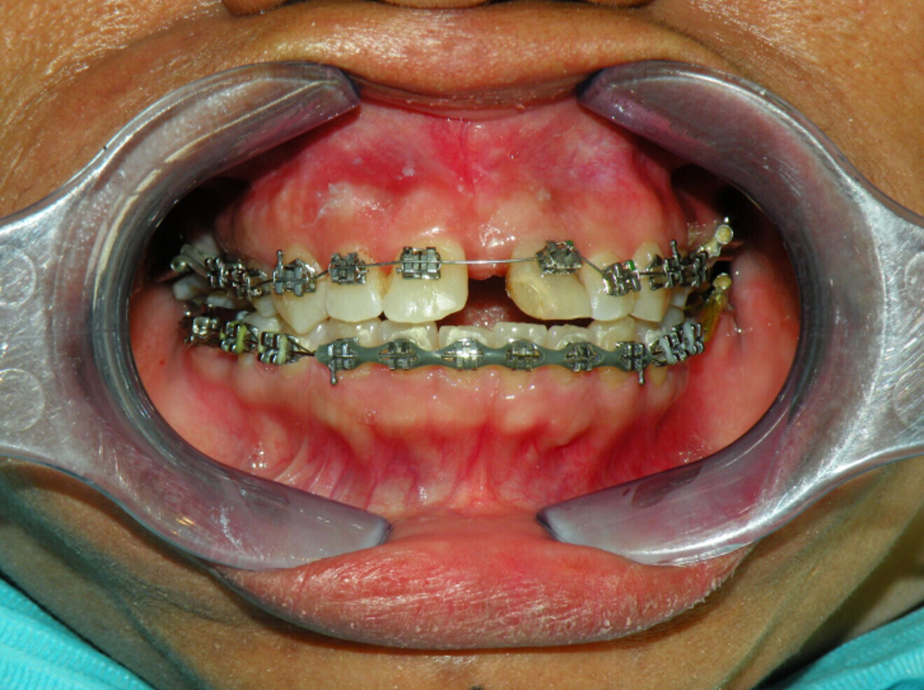 Fig 12b:  Upper arch bonded once spaces in lower arch managed.