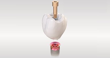 Kooperation von TRI Dental Implants und Amann Girrbach: Implantate ohne Abutment im vollstädig validierten Workflow