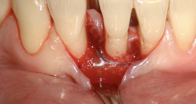 Rigenerazione Parodontale con membrana GUIDOR matrix barrier: difetti intraossei e forcazioni