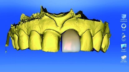 Réhabilitation esthétique antérieure par CFAO directe : à propos d’un cas clinique