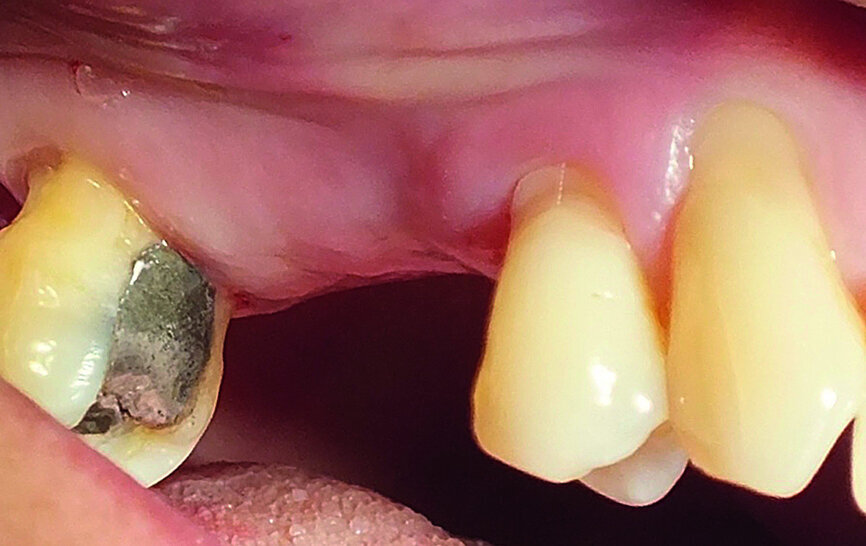 Fig. 1: The patient’s upper right first molar and second premolar had been missing for several years.