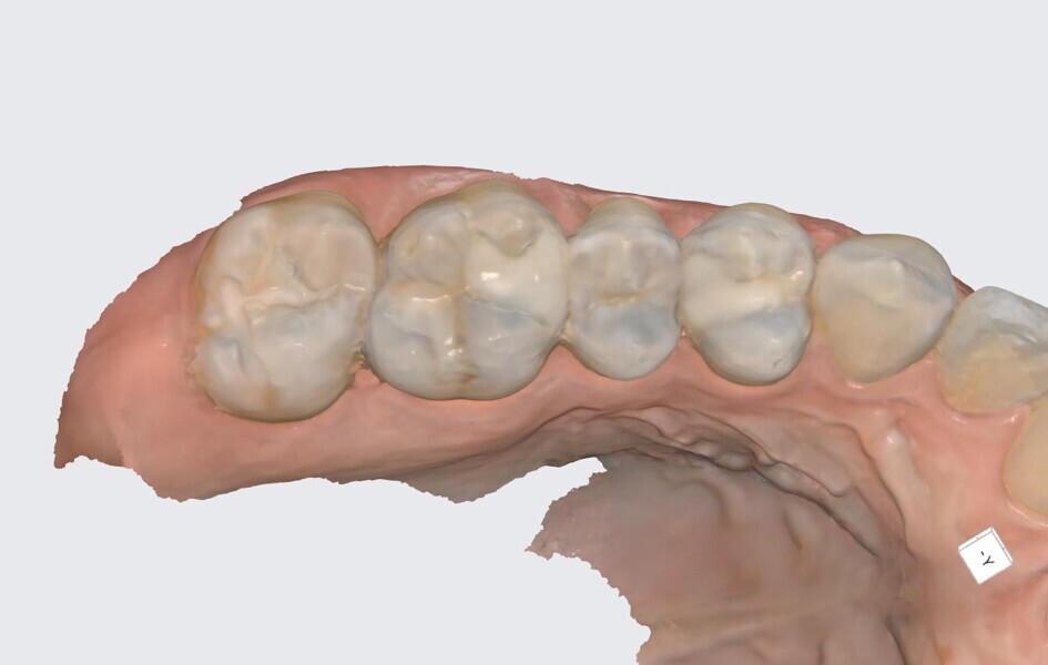 Fig. 21: Pre-op scan of the maxillary right posterior sextant.