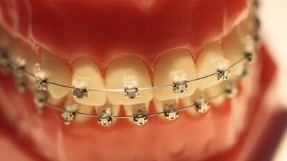 Czas noszenia aparatu ortodontycznego można skrócić