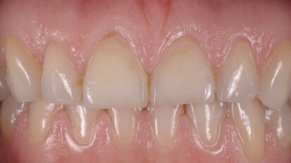 Réhabilitation biomimétique de deux centrales érodées