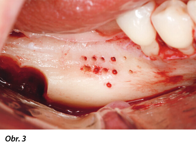 Recipientní oblast kosti byla opatřena několika dekortikačními otvory a autogenní kost byla odebrána ze zevního šikmého hřebene za použití poloviny z 4mm trepanu.