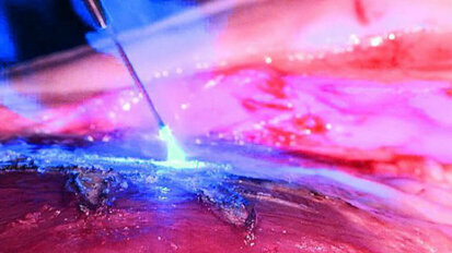 Il laser in odontoiatria un mercato in costante crescita