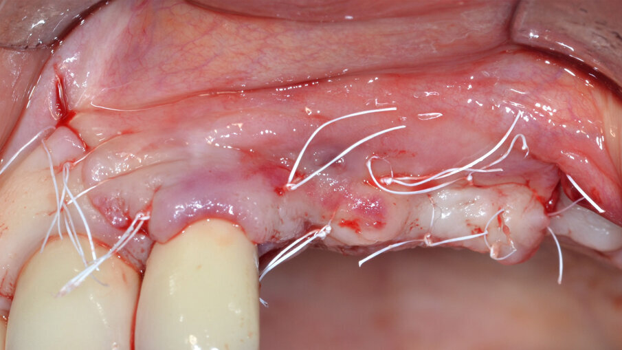 Fig. 11 - Si evidenzia una soddisfacente quantità di tessuto neoformato e il completo riempimento del difetto osseo.