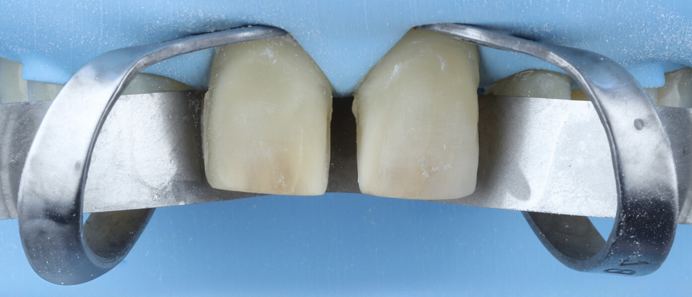 Fig. 14b: Surface appearance after air abrasion, showing a uniformly roughened substrate. 
