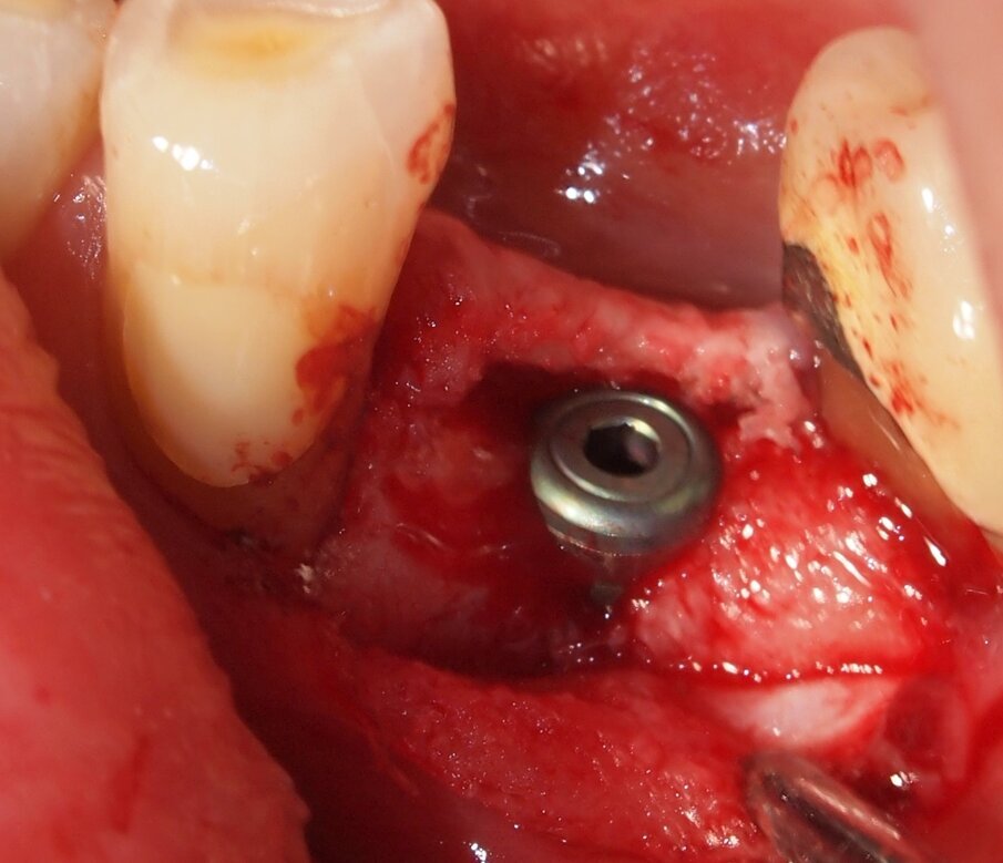 Fig. 7 - Caso clinico 1. Posizionamento di una fixture di dimensioni adeguate al caso clinico in esame.