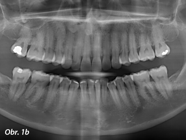 Pacientka 1 – Počáteční telerentgen a panoramatický rentgen.