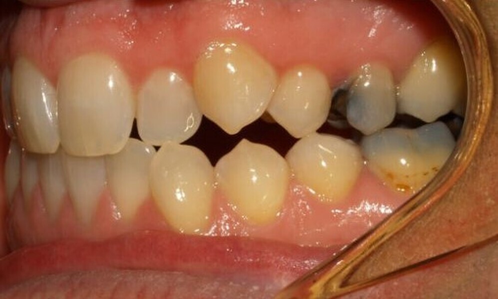 Fig. 7: Maxillary left canine requiring extrusion.  