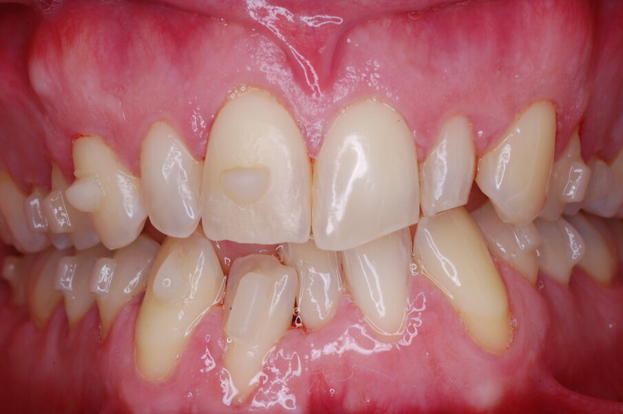 Figg. 25-29_Progressi clinici dopo 12 mesi di trattamento con allineatori.