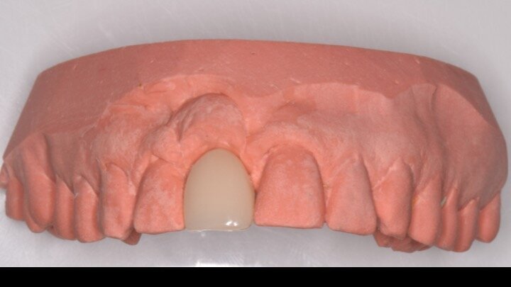 Figuras 12 y 13. En el laboratorio realizan la prótesis provisional en acrílico sobre un semicalcinable con conexión mecanizada para verla en la radiovisiografía (RVG). Dicha prótesis provisional tendrá un perfil de emergencia cóncavo para dejar ese espacio vacío que ocupará el coágulo sanguíneo, transformándose en tejido conectivo posteriormente.