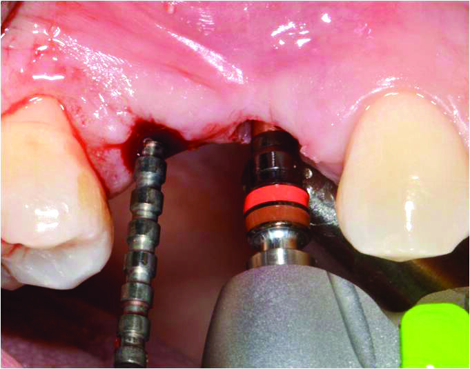 Fig. 5_Il pin di profondità guida la preparazione del sito del 14 con una leggera inclinazione distale della fresa per evitare di impattare la radice del 13.