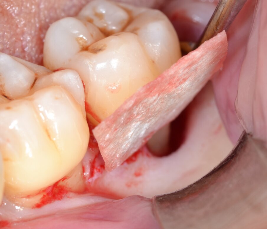 Fig. 9 - Allocazione della membrana barriera sull’aspetto linguale.
