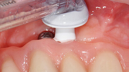 „Prevence 0“: nejúčinnější prevence periimplantitidy?