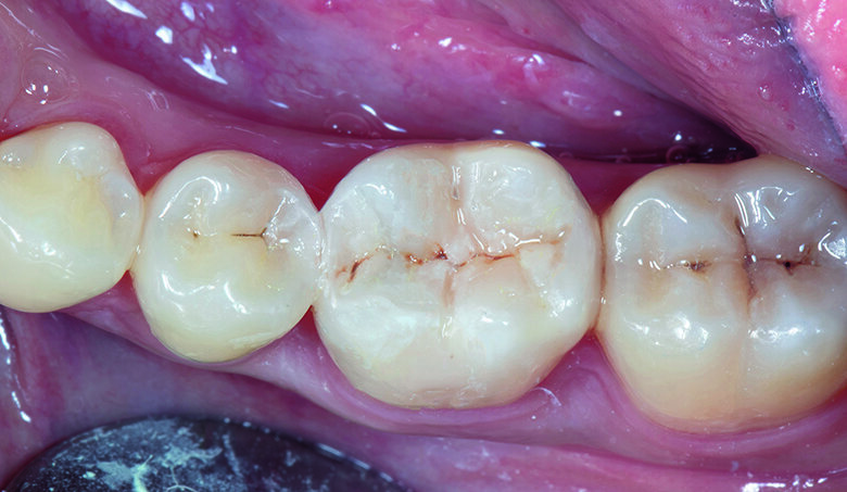Fig. 14. Post-op after 7 days -  Final Invisible Restorations.  
