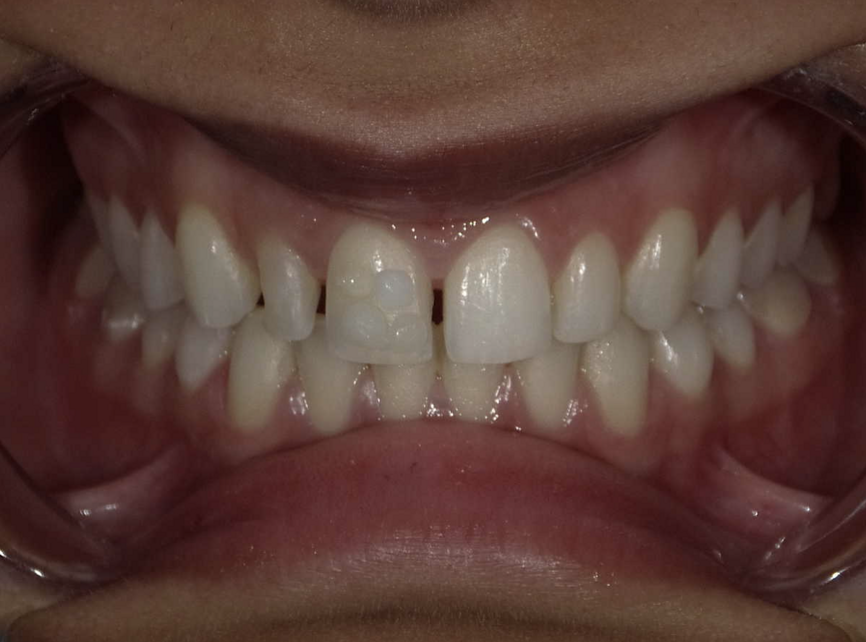 Fig 11 : Final recipe of shades for the restoration 