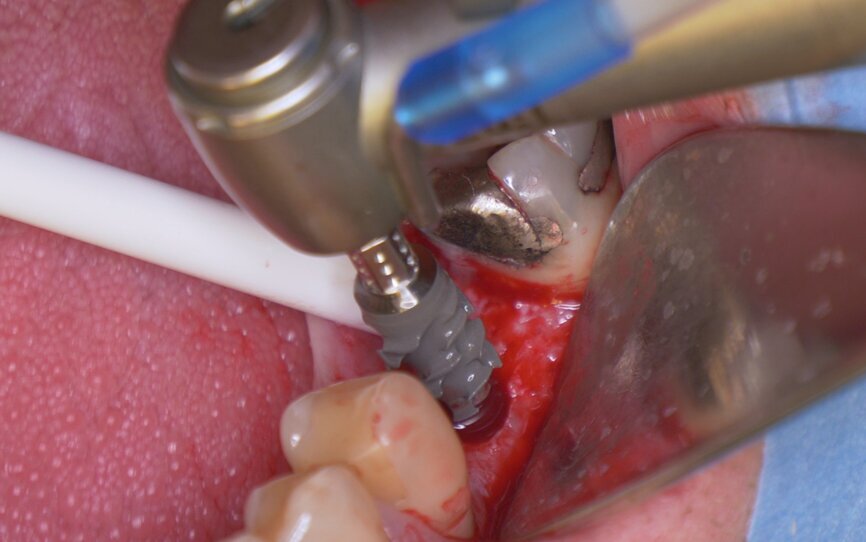 Fig. 4: Implant insertion with the handpiece at 15 rpm.
