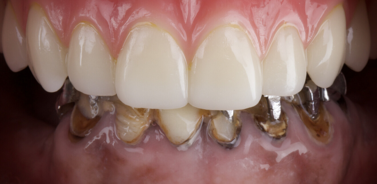 Fig. 7: Intra-oral frontal view of the maxillary provisional prosthesis delivered on the fourth day after maxillary surgery.