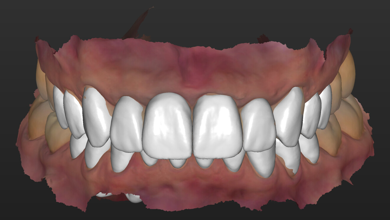 Fig. 4: Completed digital wax-up for the maxilla and mandible.