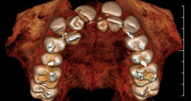 Clinical and diagnostic advantages using the PreXion 3-D cone-beam imaging system