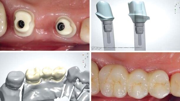 Łączniki indywidualne w odcinku bocznym