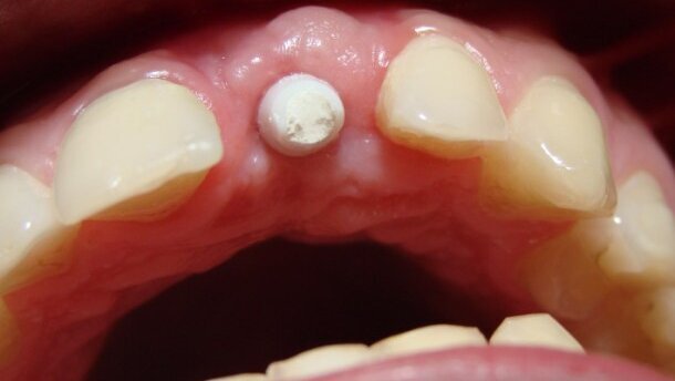 Implantoprotetyczne odtworzenie brakującego zęba 21 – opis przypadku