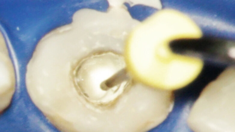 Aplikace MTA s použitím Produit Dentaires (PD) MAP System