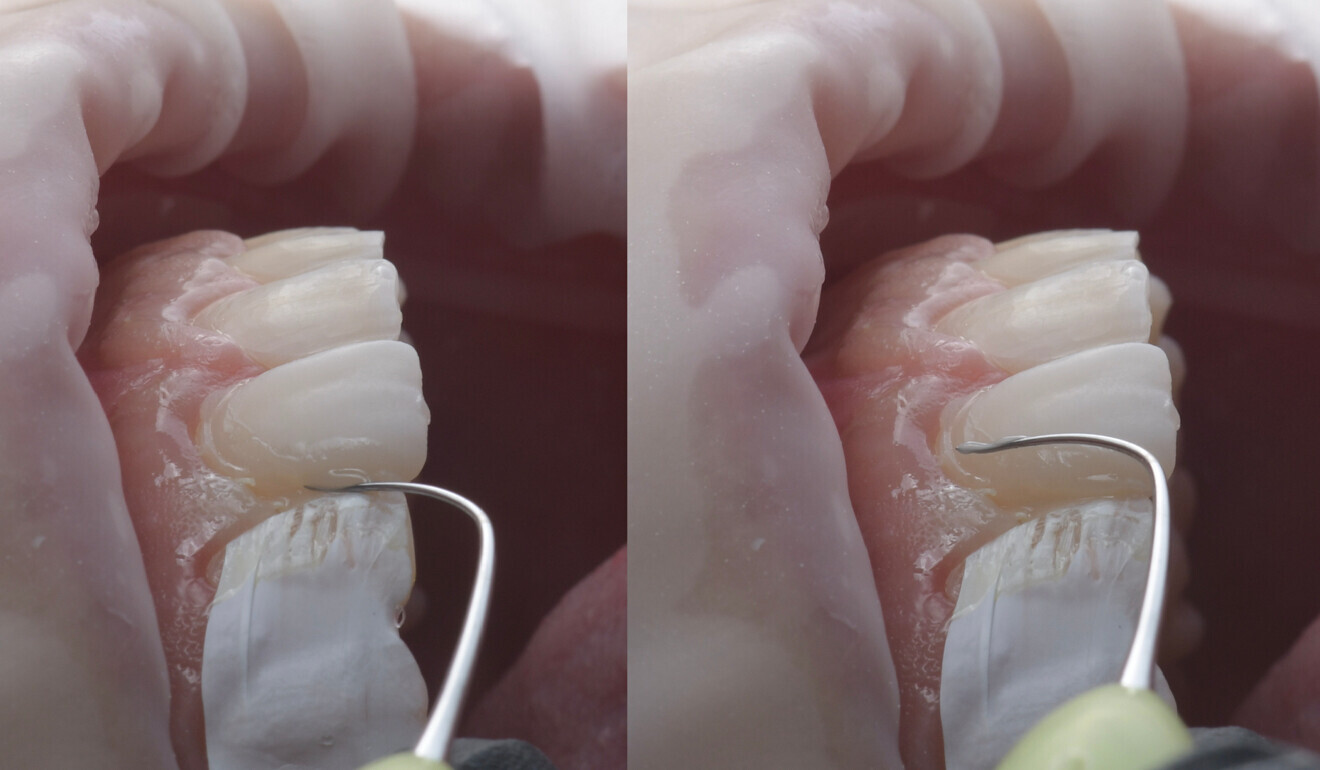 Fig. 13: Flowable composite spreading and excess removal.
