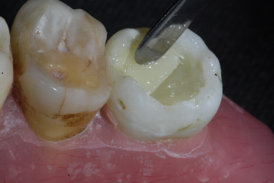 Fig. 27a: The subsequent dose of fibre-reinforced membrane cube is placed to protect the remaining walls of the cavity.