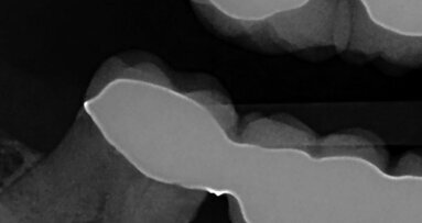 Bioactive materials: A new approach to dental care