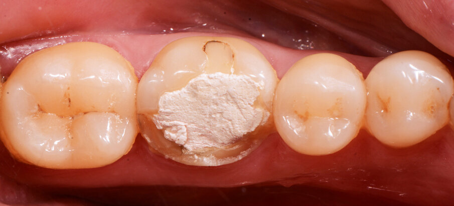 Fig. 1: Pre-op situation. 