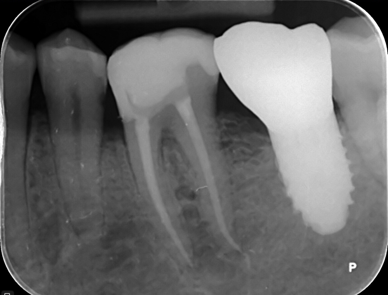 Fig. 25b: Radiographic post-op view of tooth #36 after endodontic treatment and restoration.