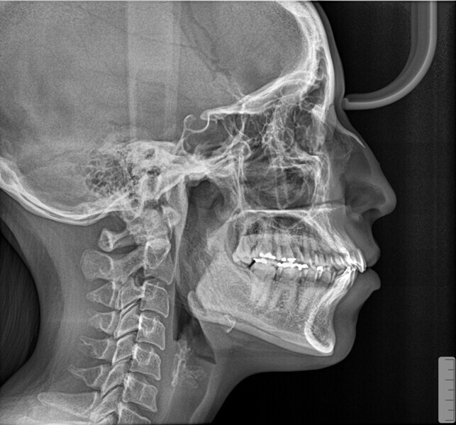 Fig. 4a: Initial cephalometric radiograph and dental panoramic tomogram.