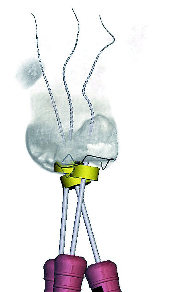 Fig. 11: The software projects ISO size 06 instruments into the canals that allows the operator to visualise the internal anatomy of the root canals.