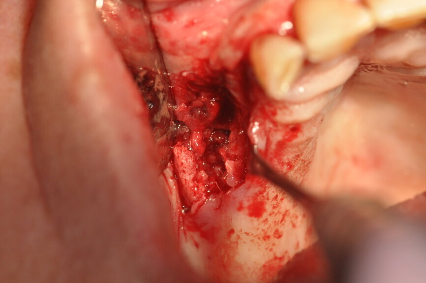 Ryc. 1-3_Stan przed leczeniem: 3. Defekt kostny, stan po utworzeniu płata w celu uzyskania wglądu w pole zabiegowe.