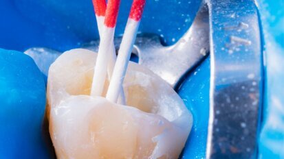 A rare variation in the root canal anatomy of a premolar